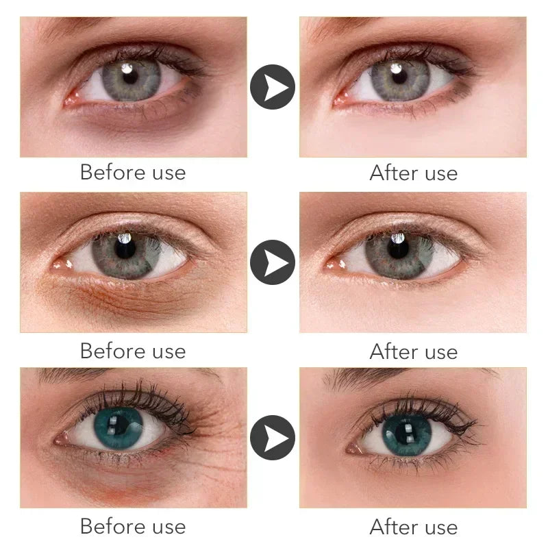 Eye Cream Remove Dark Circles